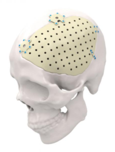 Implant czaszki wydrukowany w technologii 3D na podstawie tomografii komputerowej pacjenta